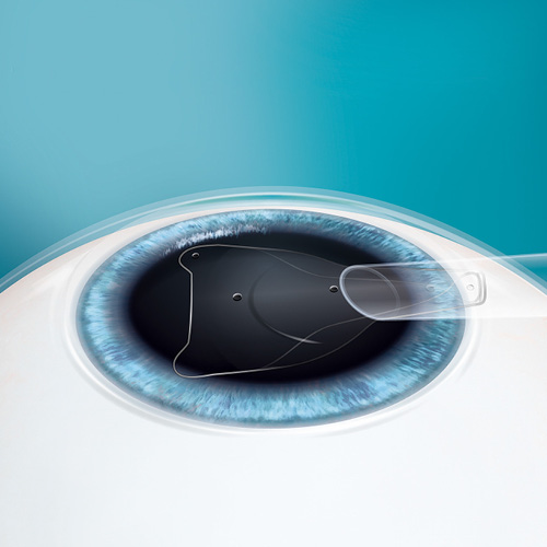 staar surgical evo icl phakic collamer lens4 - 